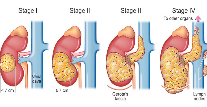 Stages of Kidney Cancer