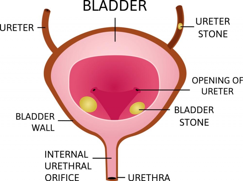 Urinary Bladder Stone Treatment in Pune Dr. Irfan Shaikh