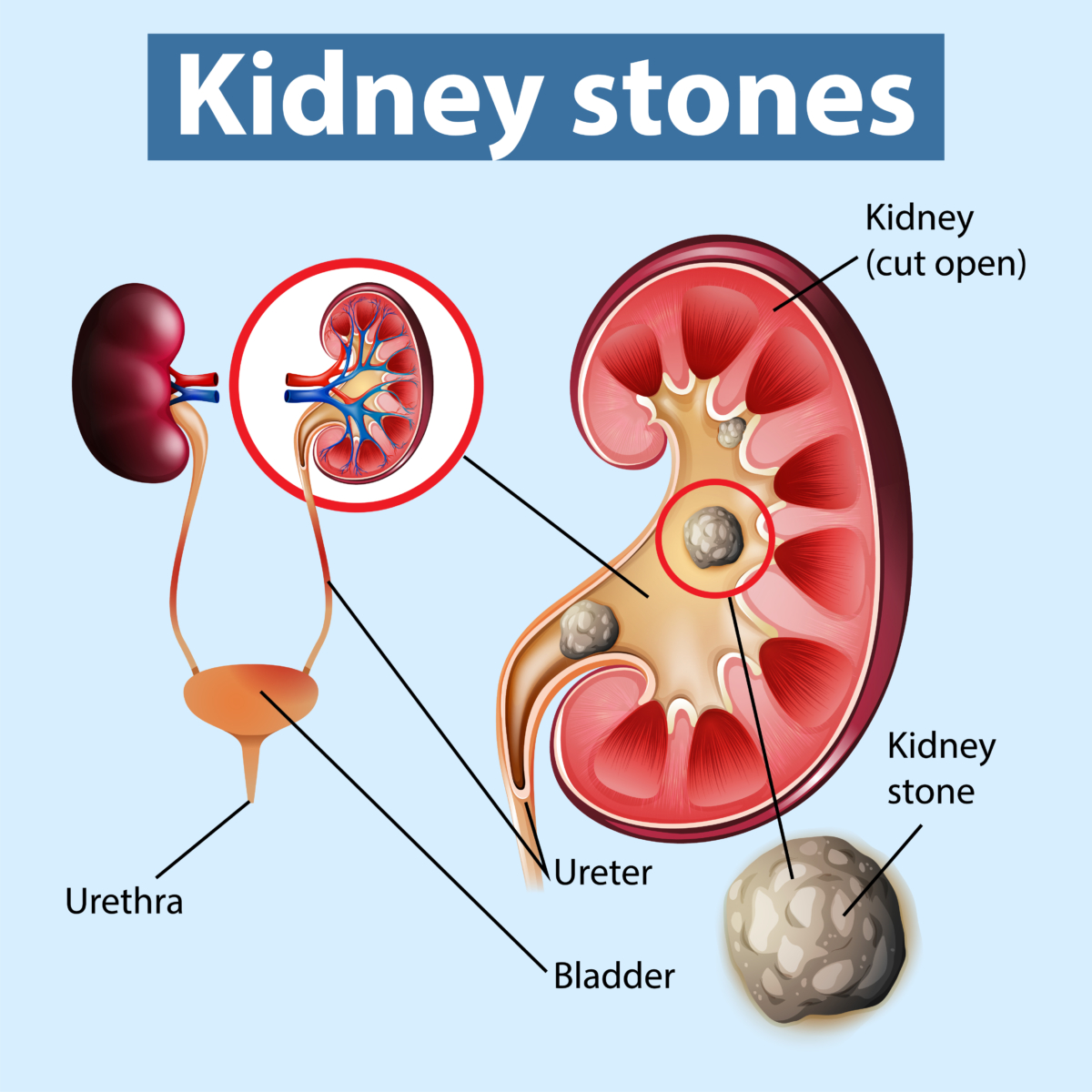 RIRS Surgery for Kidney Stone Removal Urolife Clinic, Pune