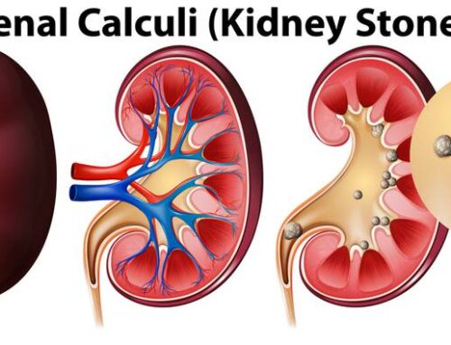 RIRS vs ESWL for the treatment of Renal Kidney Stone