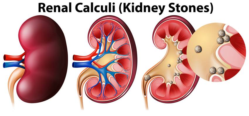 Renal Kidney Stone Treatment In Pune