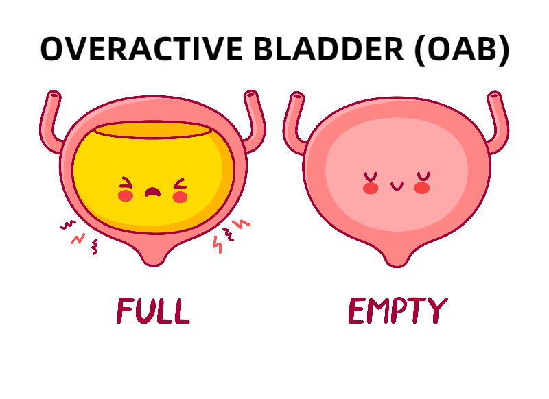 Best Treatment on Overactive Bladder OAB in Pune
