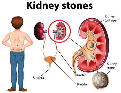 Foods that can cause Kidney Stone