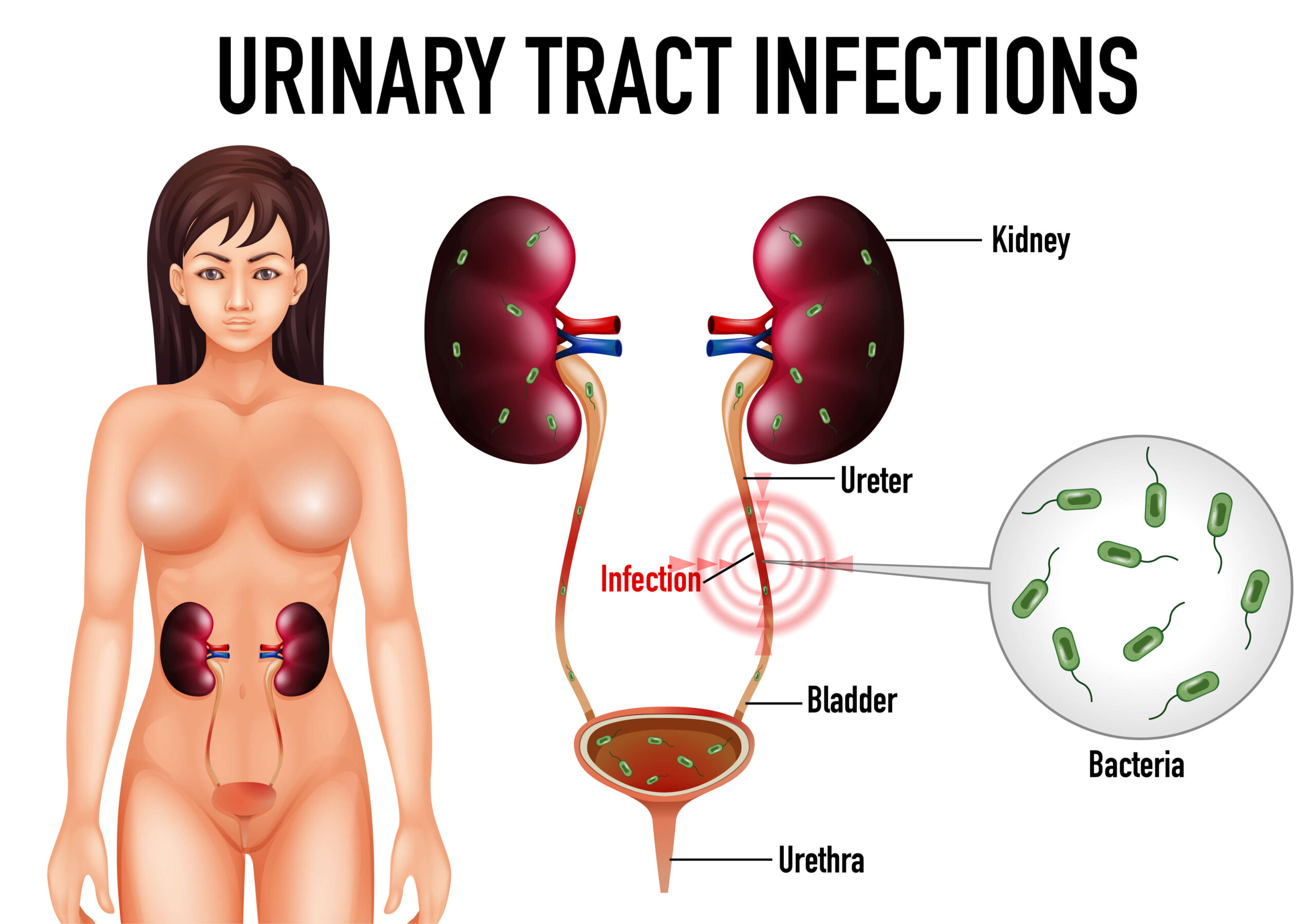 Urinary tract infection (UTI) treatemnt in Pune by Dr. Irfan Shaikh