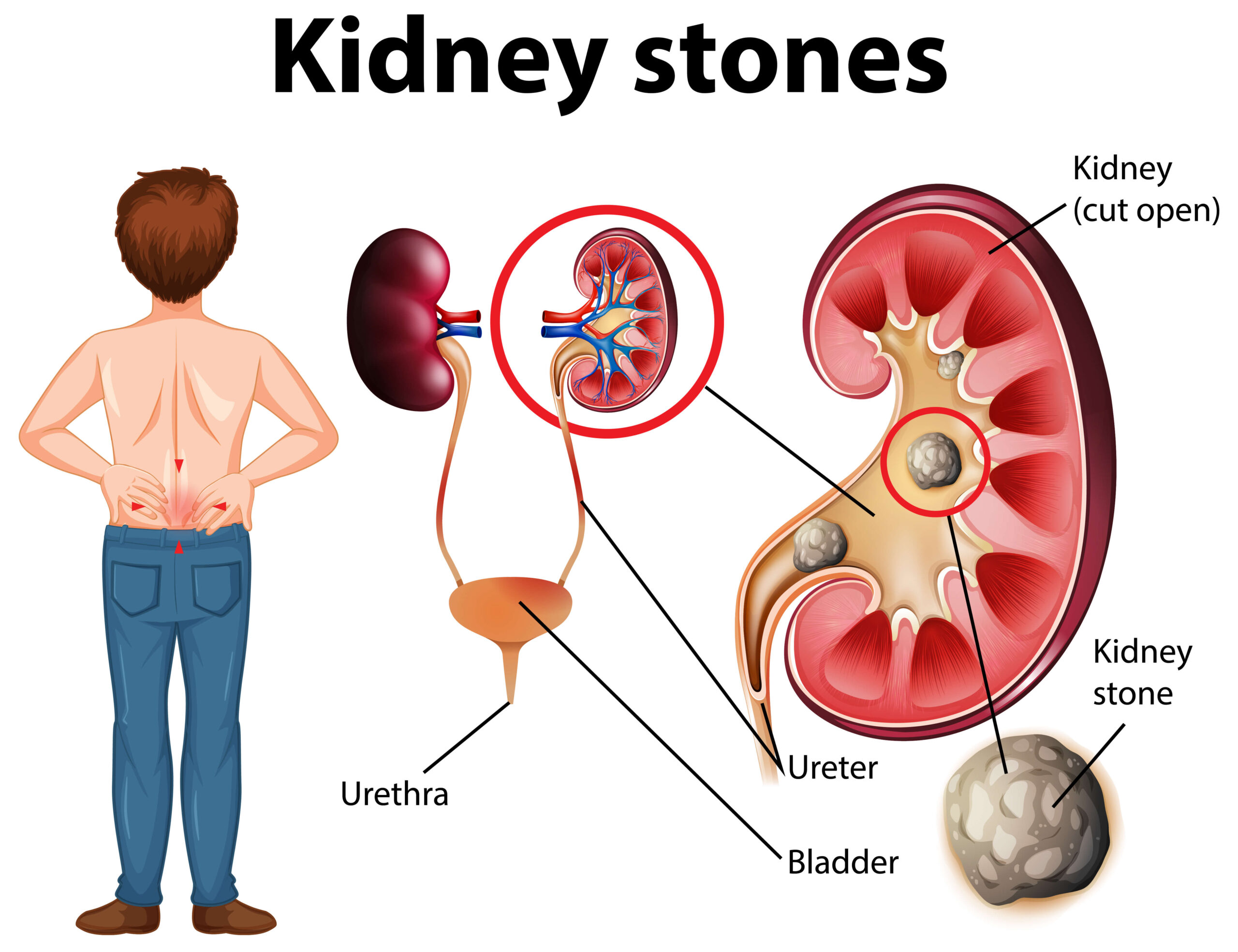 किडनी स्टोन (Kidney Stone)
