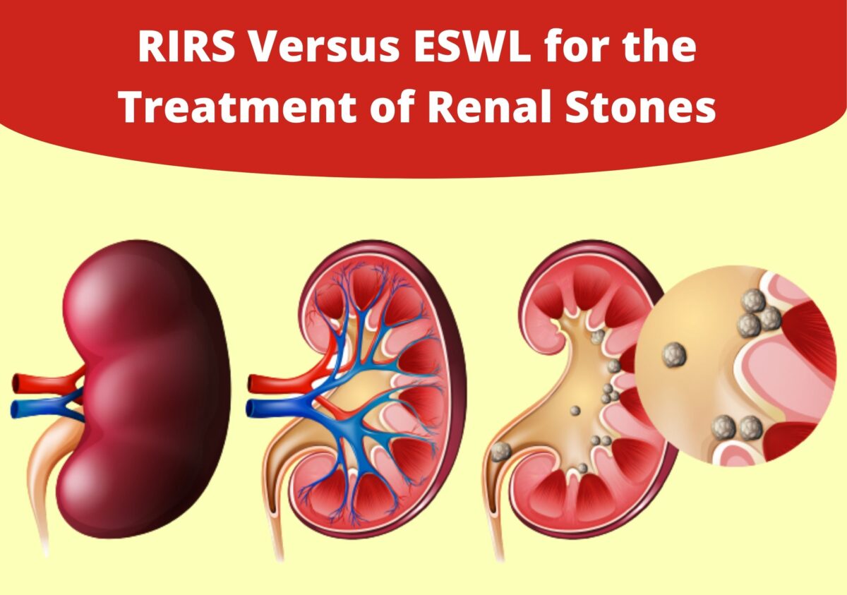 RIRS Versus ESWL for the Treatment of Renal Stones UroLife Clinic