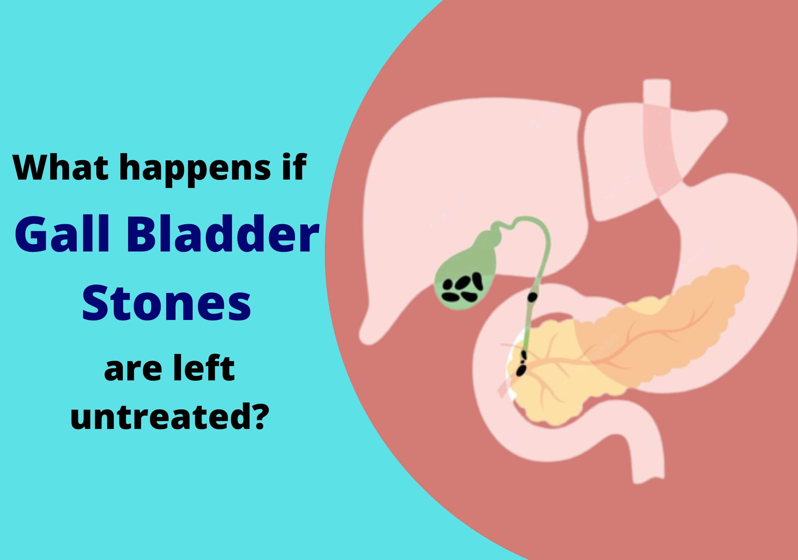 Gall Bladder Stones Treatment in Pune