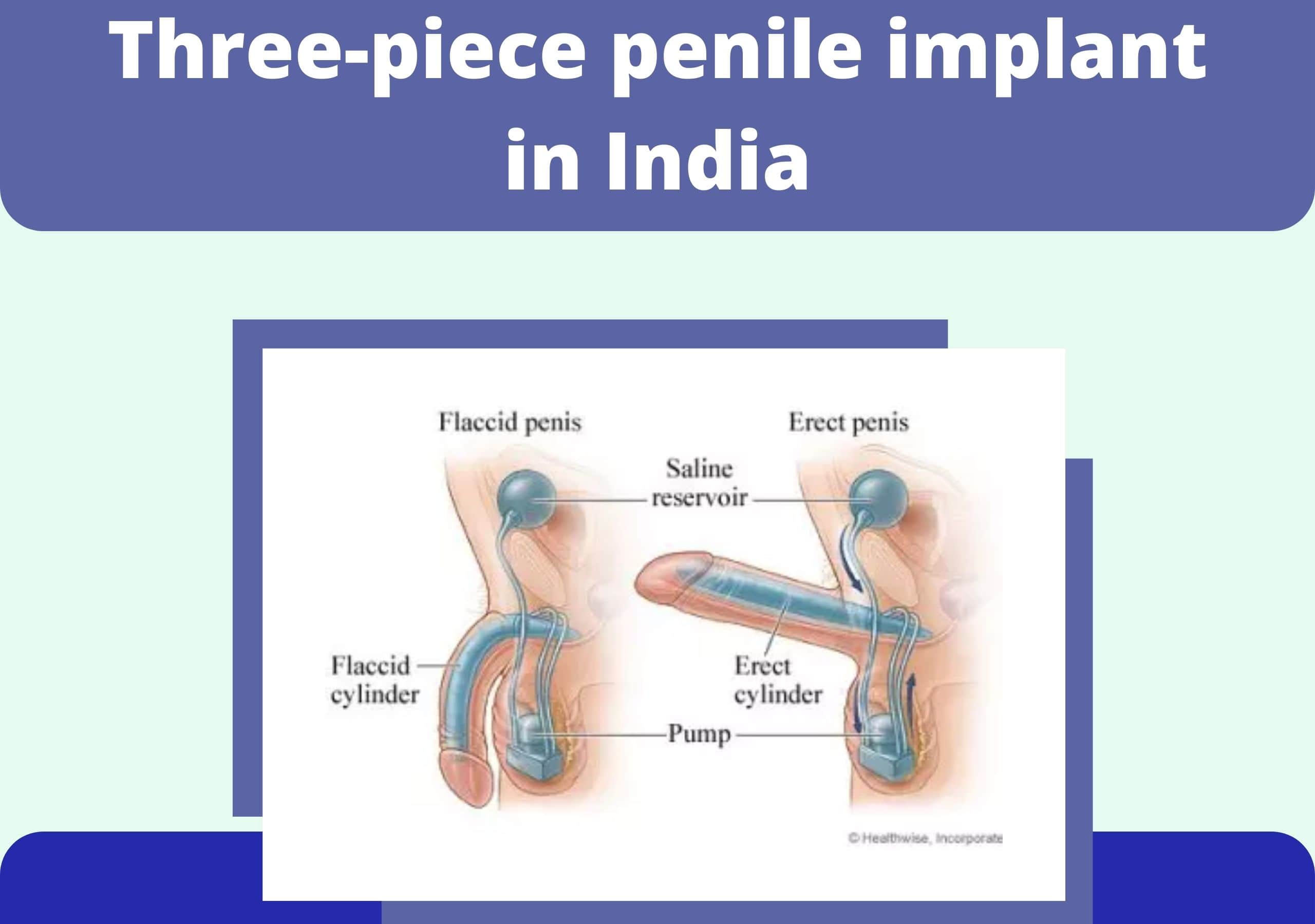 Penile implant Surgery in Pune | Urolife Clinic