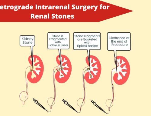 Retrograde Intrarenal Surgery for Renal Stones