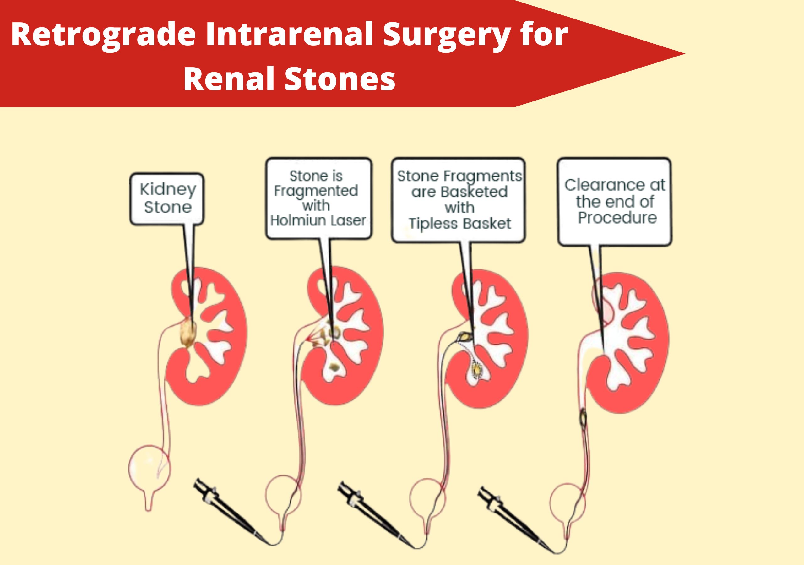 Retrograde Intrarenal Surgery( RIRS) Surgery in PUNE