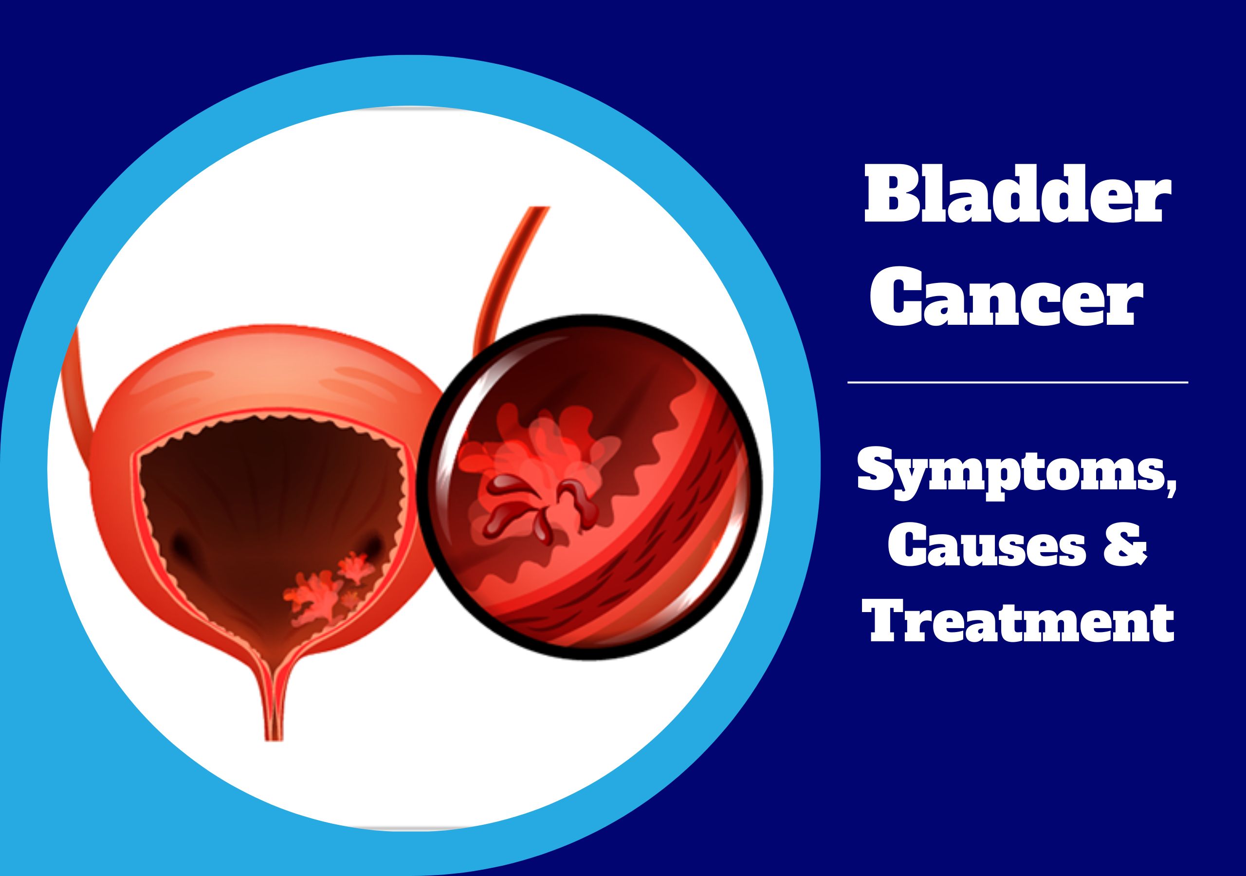 Bladder Cancer Treatment in Pune