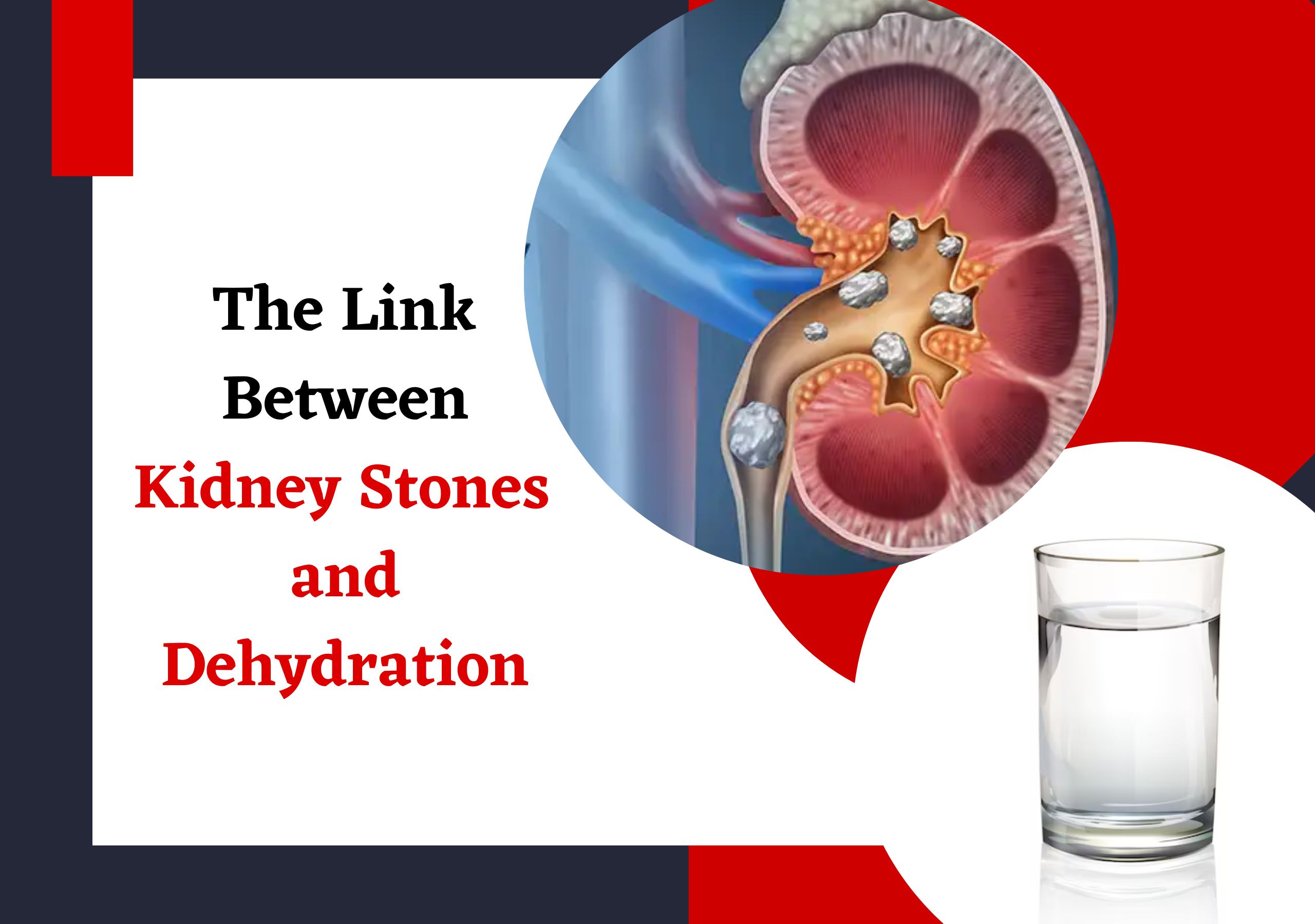 Kidney Stone and Dehydration | Urolife Clinic