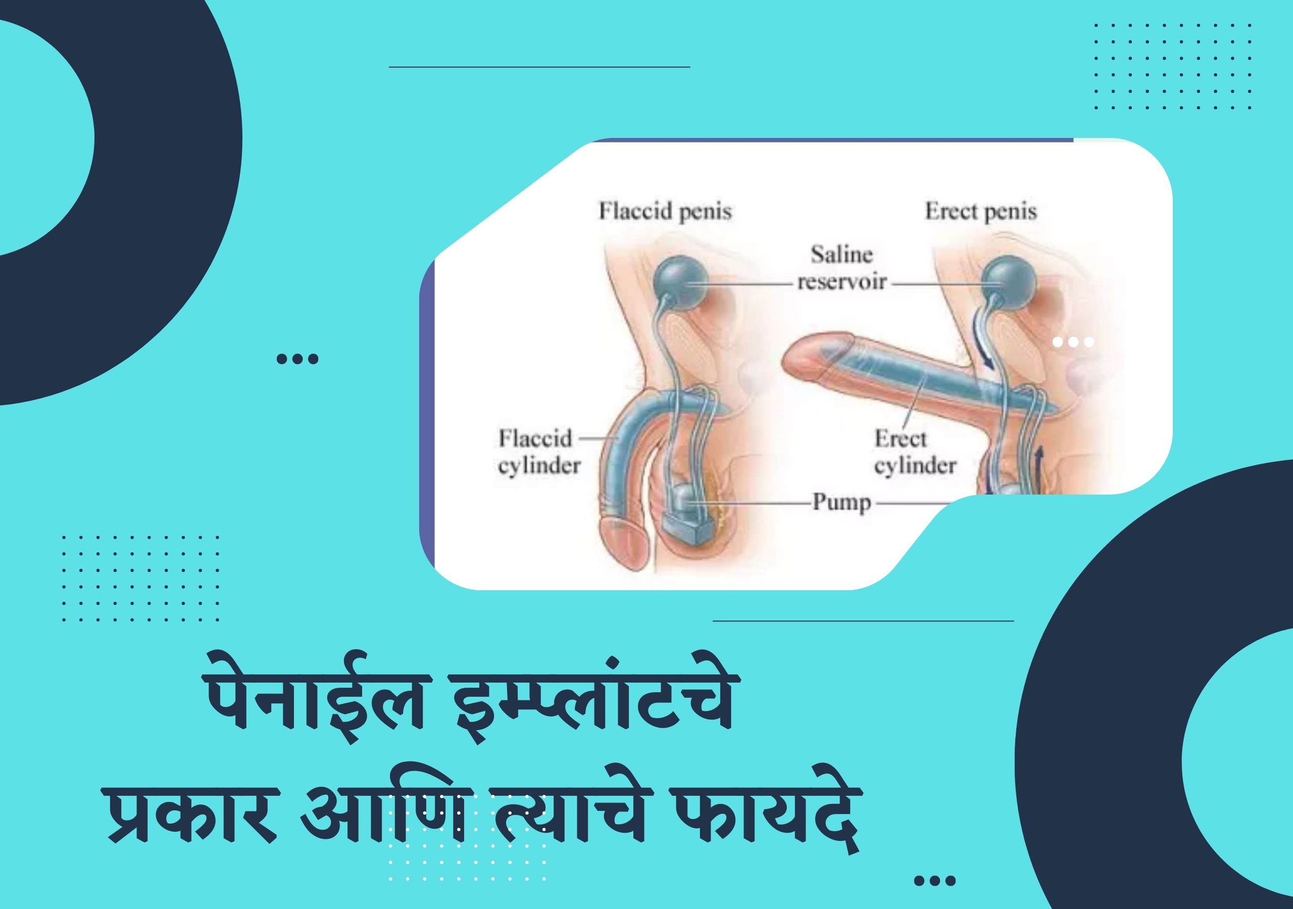 पेनाईल इम्प्लांट | Penile Implant in India | Urolife Clinic