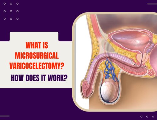 What is Microsurgical Varicocelectomy and How Does It Work?