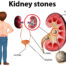 Is Kidney Stone Removal a Serious Surgery? | Dr. Irfan Shaikh
